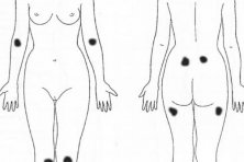 Charla sobre fibromialgia